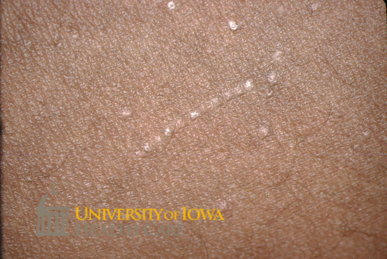 Tiny flesh-colored papules, some in a linear arrangement, on the extremity. (click images for higher resolution).